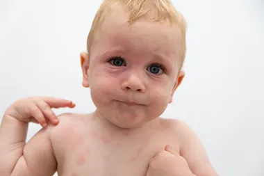 Webbinarium om barn och matallergier den 16 maj
