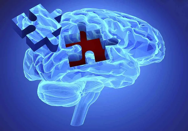 Human brain research and memory loss as symbol of alzheimer’s concept with missing pieces of the puzzle